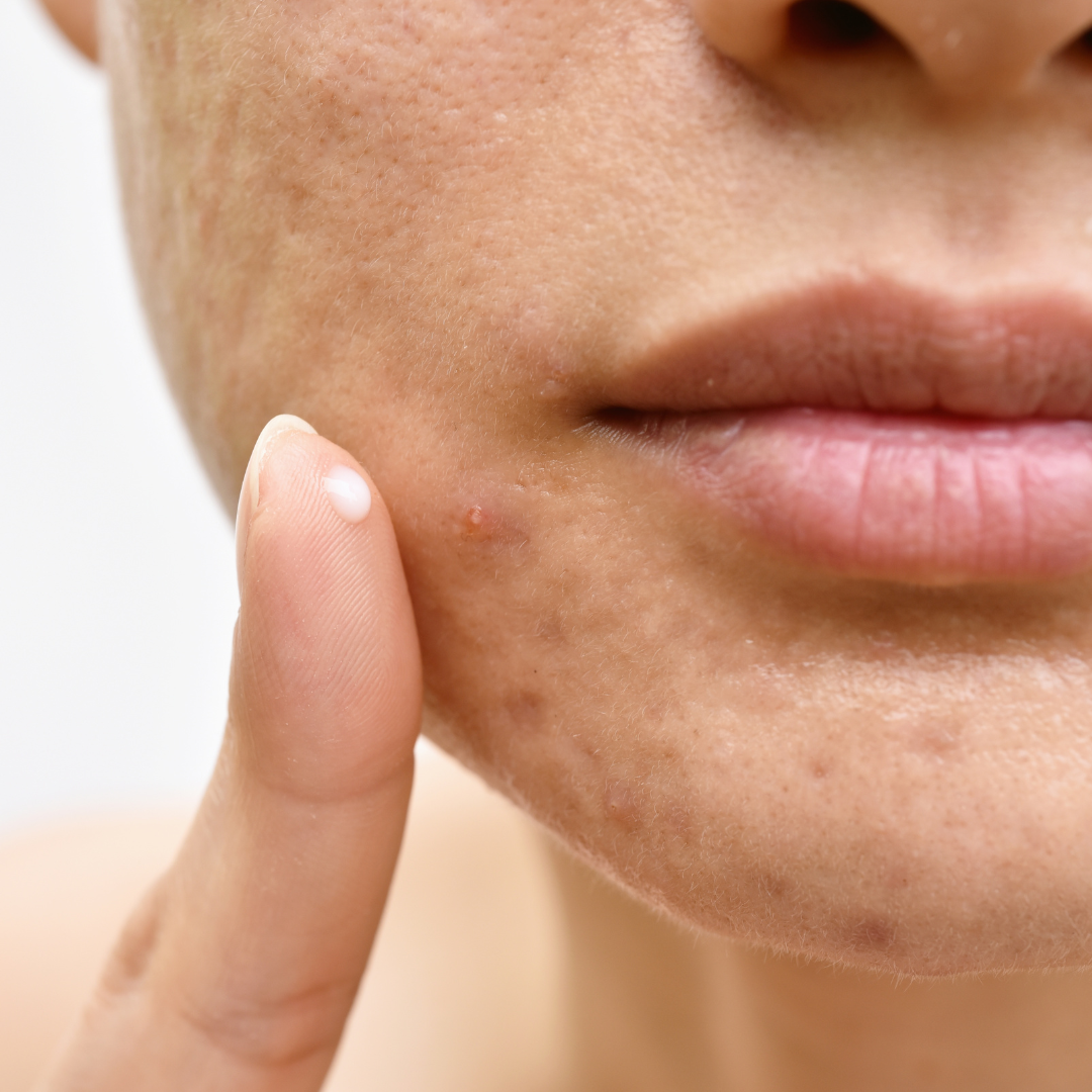 Acne, break outs, scarring Skincare Plant-based, Vegan, Sustainable Australia The Bod Society